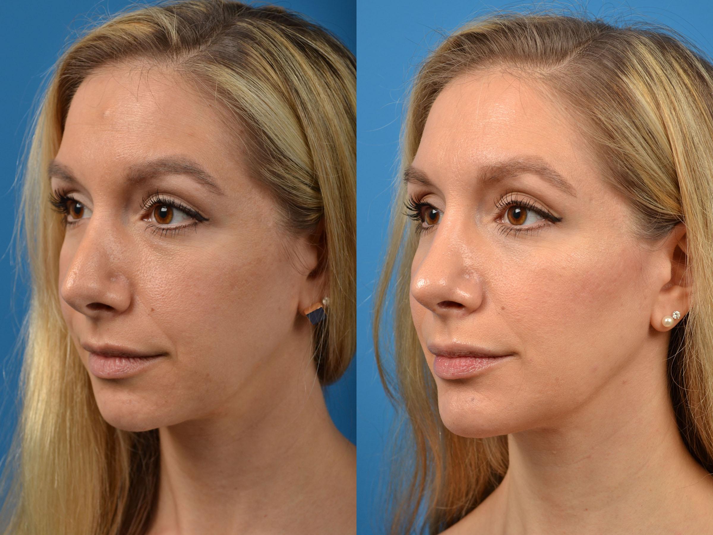 rhinoplasty-photos-melbourne-fl-patient-56566